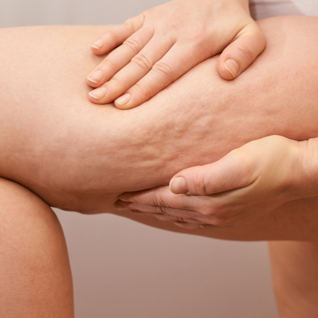 Traitement cuisses et cellulite Alma Accent Prime